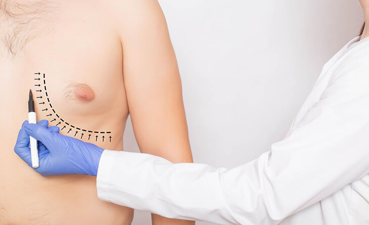 Gynecomastia Recurrence: Is It A Real Concern - Dr. Lokesh Handa