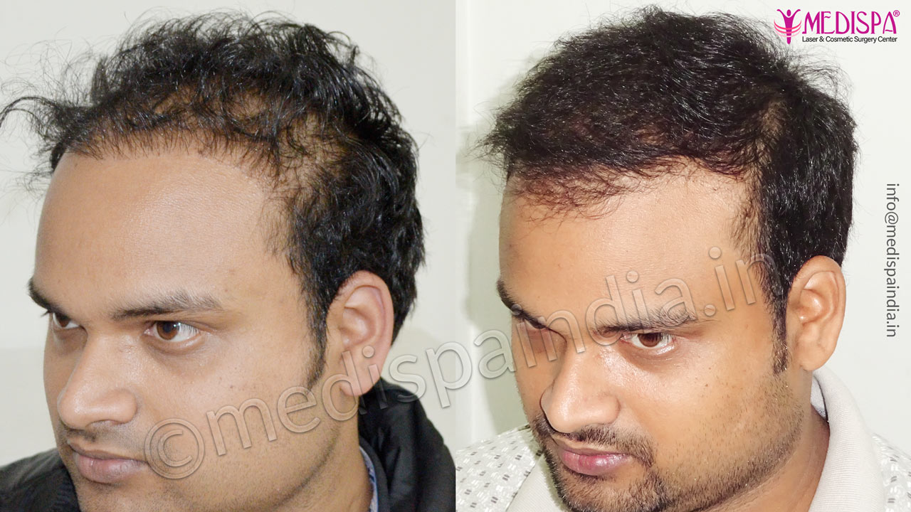 Hair Transplant Procedure in Delhi at Med Esthetiks!